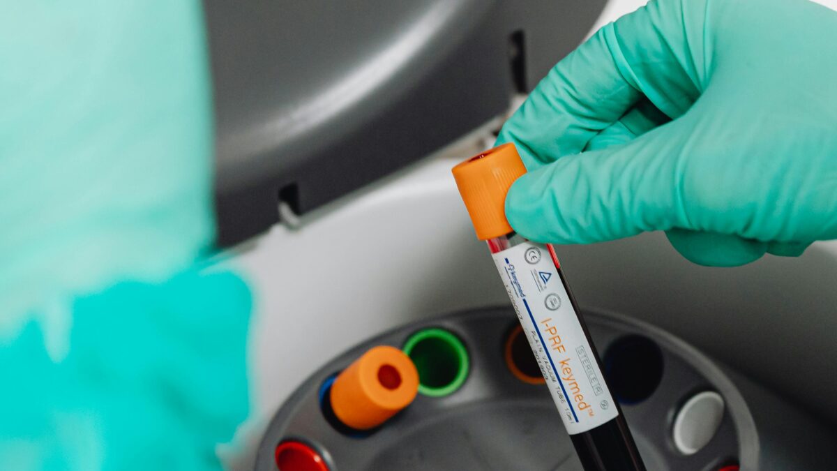 CRP y GlyaC son buenos marcadores de inflamación